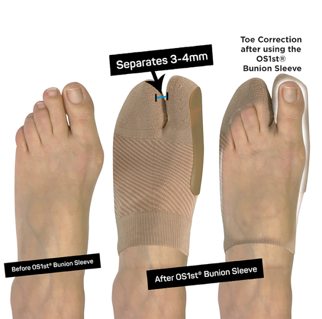 Bunion Bracing Sleeve