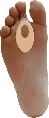 Callus Pad J-9